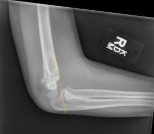 Elbow Fractures – Undergraduate Diagnostic Imaging Fundamentals