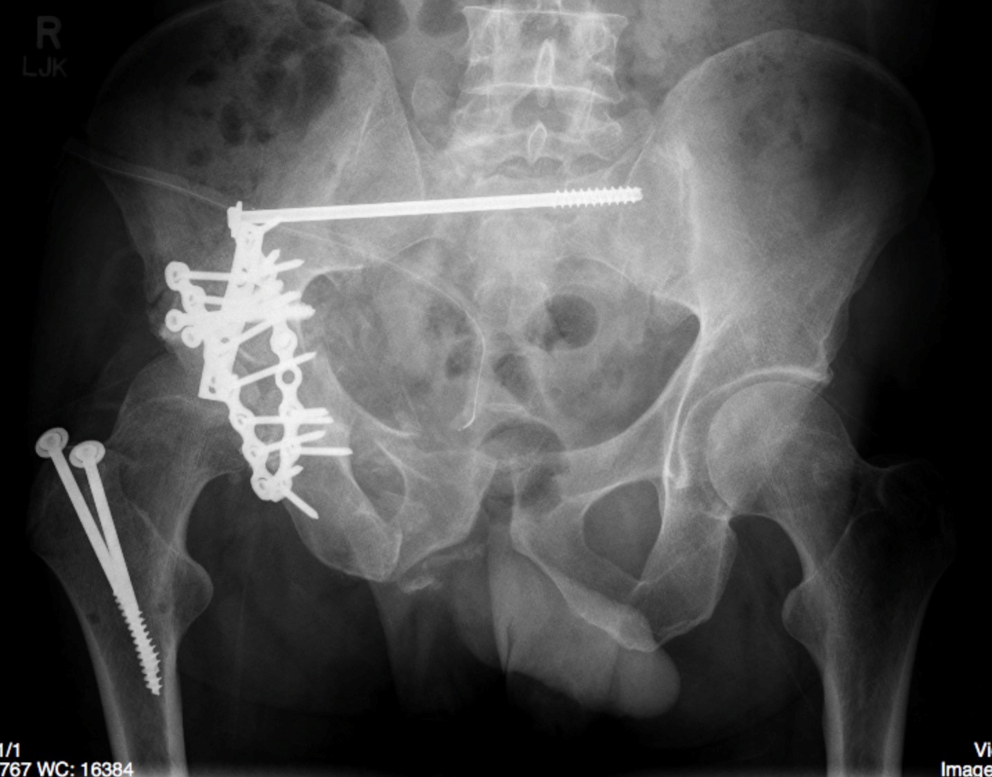 pelvic-fracture-undergraduate-diagnostic-imaging-fundamentals