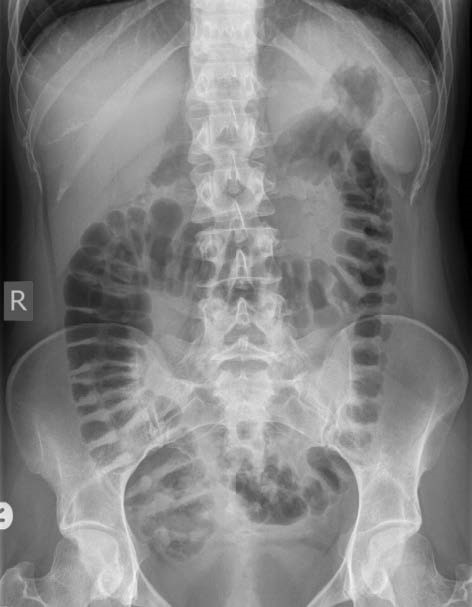 Approach to the Abdominal x-ray (AXR) – Undergraduate Diagnostic