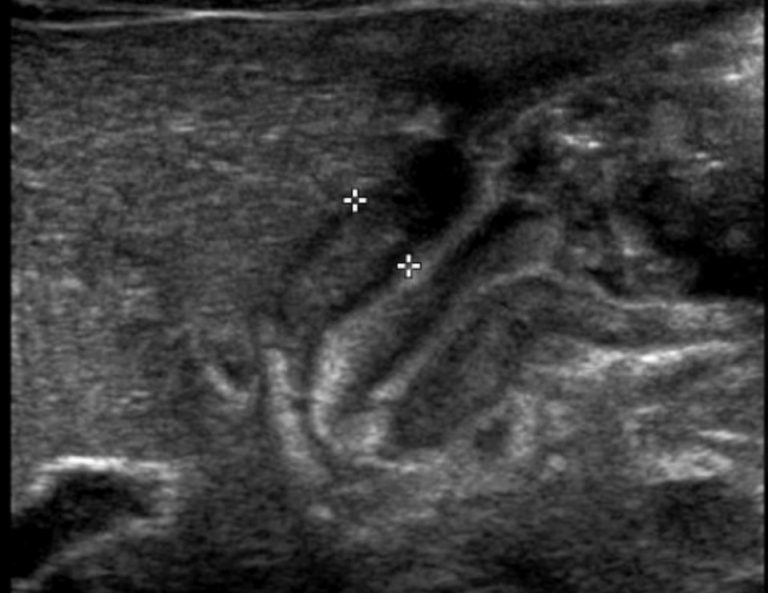 Pyloric Stenosis Undergraduate Diagnostic Imaging Fundamentals   Ped 6 3 768x593 