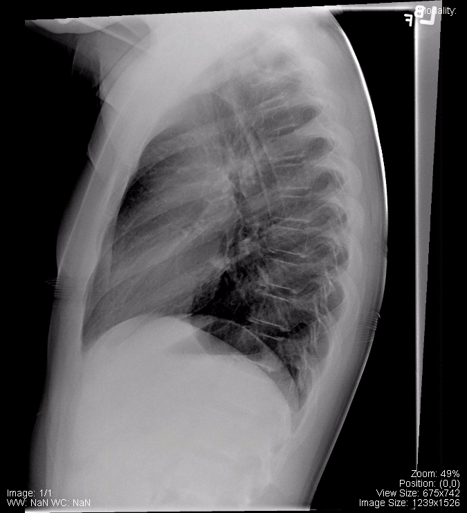 Normal Lateral Chest Radiograph
