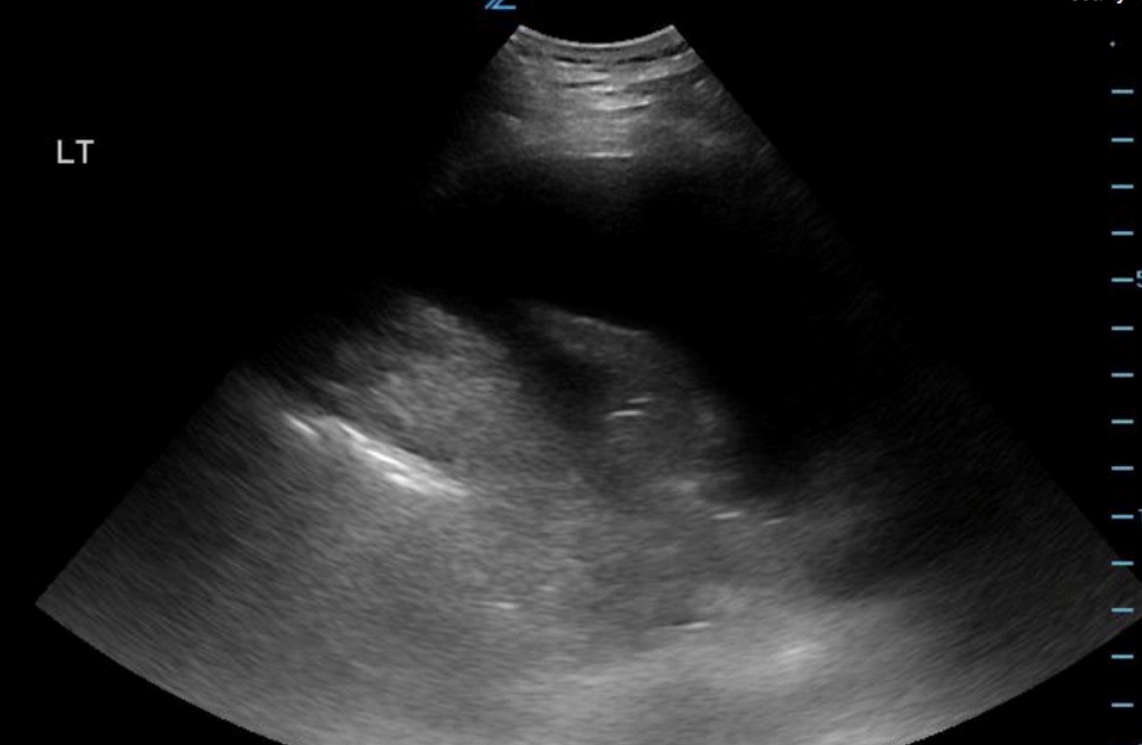 Atelectasis – Undergraduate Diagnostic Imaging Fundamentals