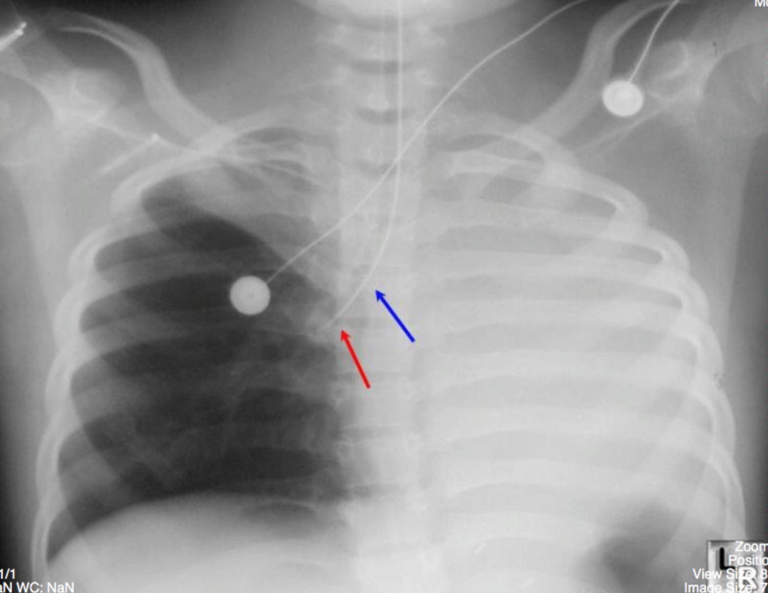 Atelectasis Undergraduate Diagnostic Imaging Fundamentals