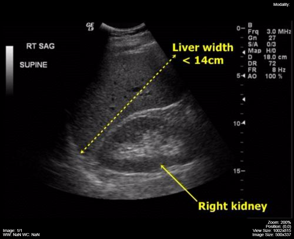 Liver Ultrasound Anatomy Anatomical Charts Posters