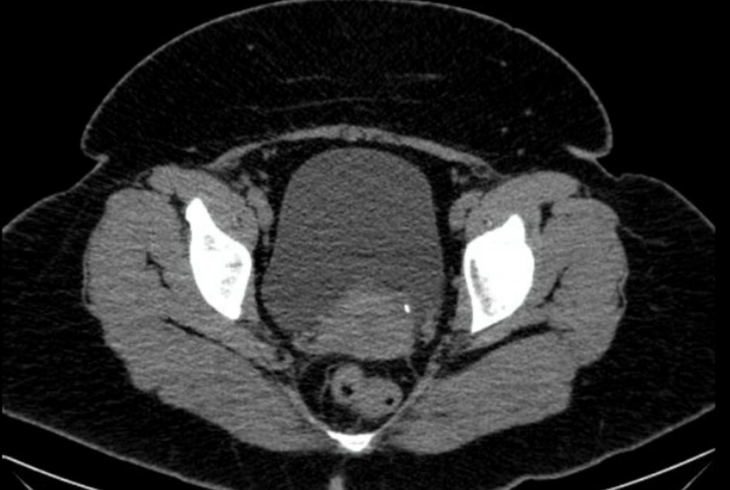 Urinary Tract Calculus – Undergraduate Diagnostic Imaging Fundamentals