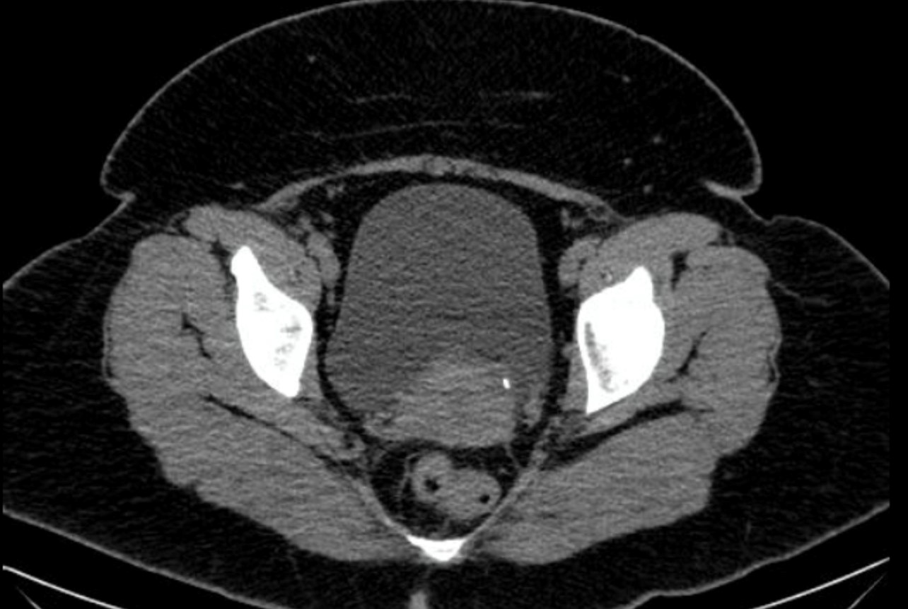 Urinary Tract Calculus Undergraduate Diagnostic Imaging Fundamentals