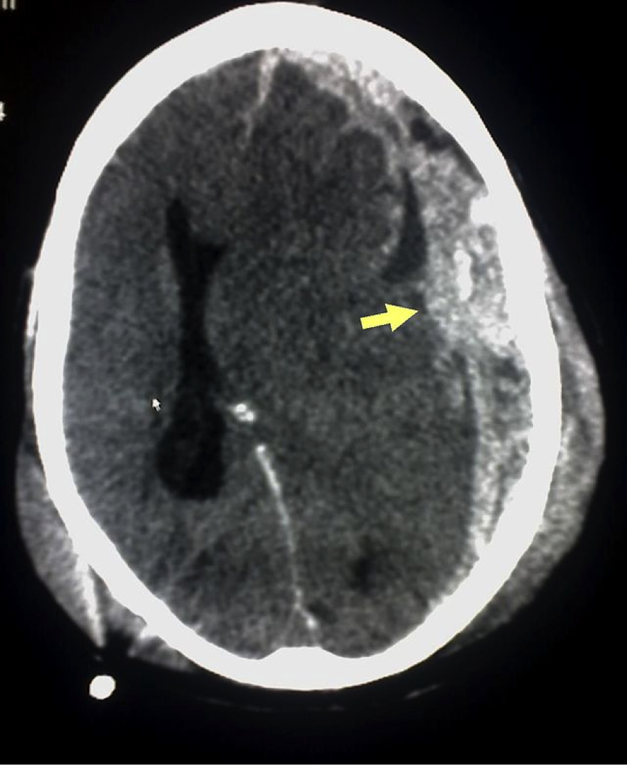 A brain scan showing bleeding in the brain.